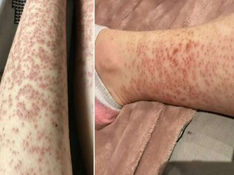 عوارض لیزر موهای زائد