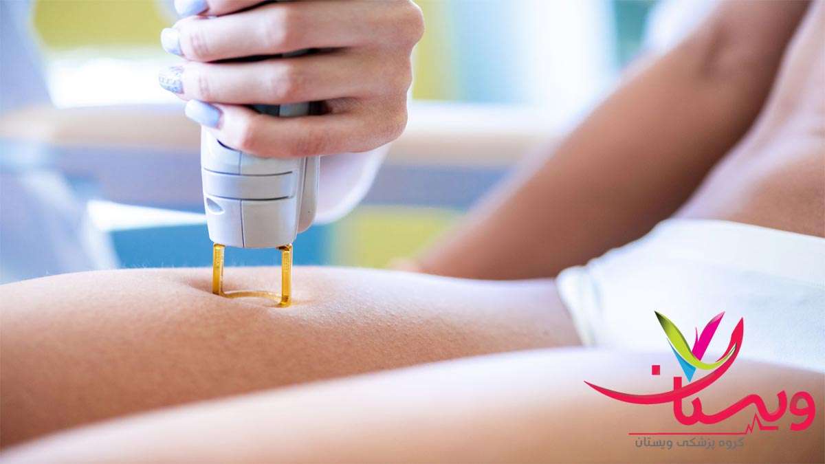 لیزر موهای زائد کل بدن در تهران(مترادف عنوان به فارسی) نحوه رفع خجالت کشیدن از لیزر واژن