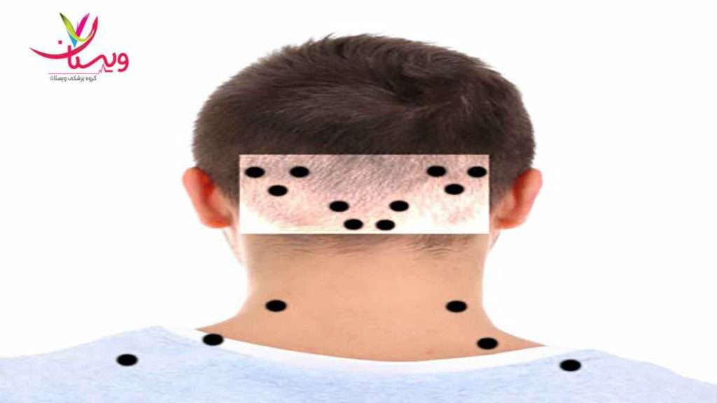 نقاط تزریق بوتاکس پشت گردن نقاط تزریق بوتاکس