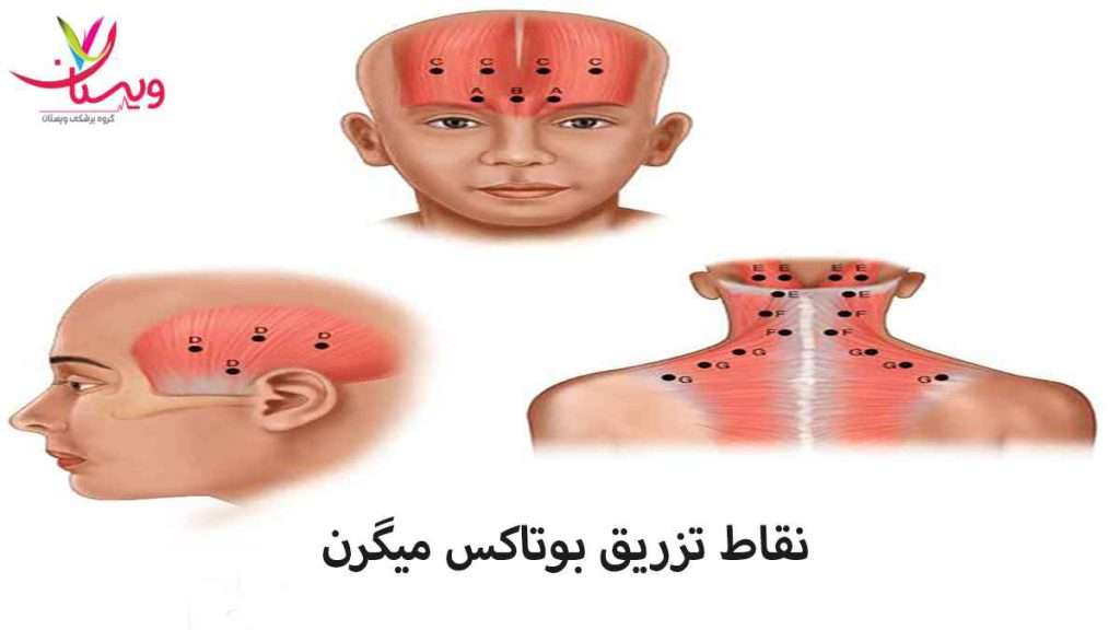 نقاط تزریق بوتاکس نقاط تزریق بوتاکس