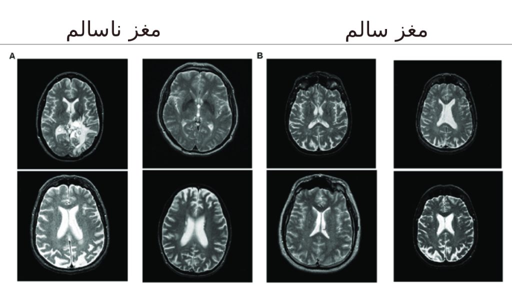 اسکن مغز ناسالم مقایسه ای از سی تی اسکن مغز سالم و مغز ناسالم