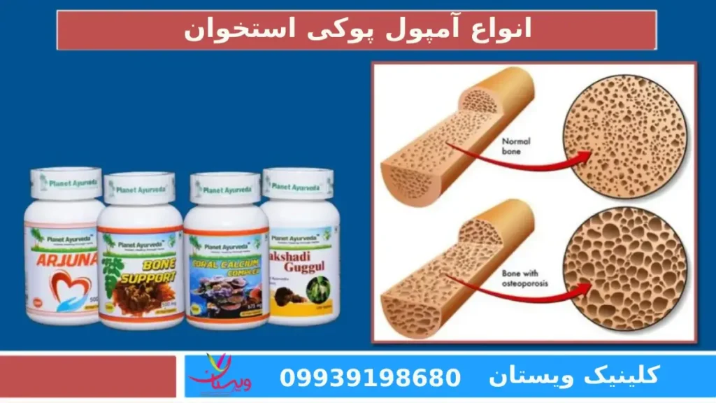 قیمت آمپول پوکی استخوان ایرانی قیمت آمپول پوکی استخوان ایرانی