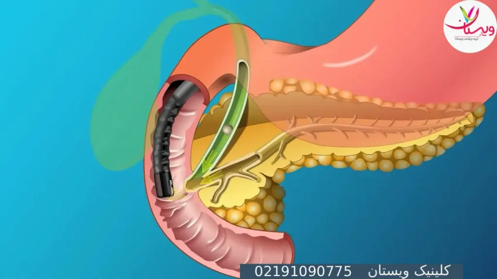 آندوسکوپی مجاری صفراوی