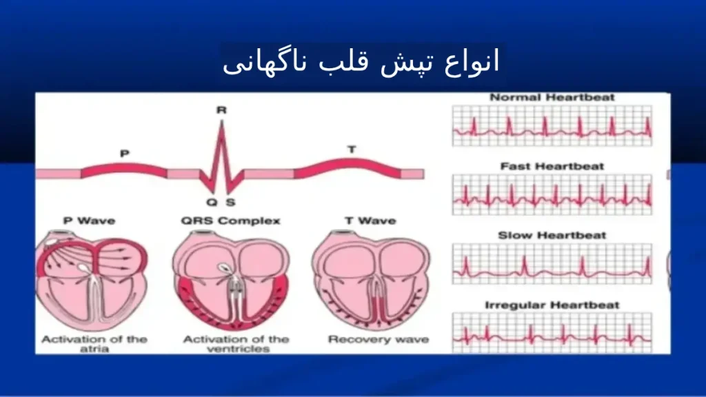 انواع تپش قلب ناگهانی انواع تپش قلب ناگهانی
