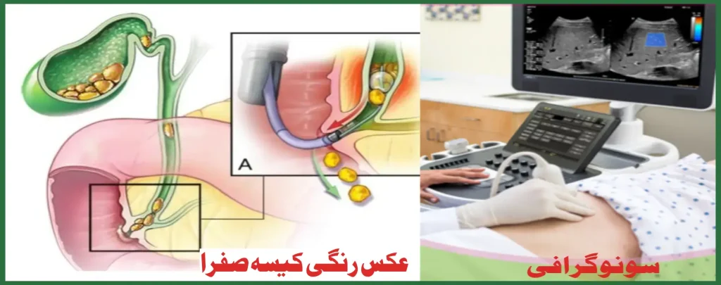 عکس رنگی کیسه صفرا و سونوگرافی ویستان عکس رنگی کیسه صقرا