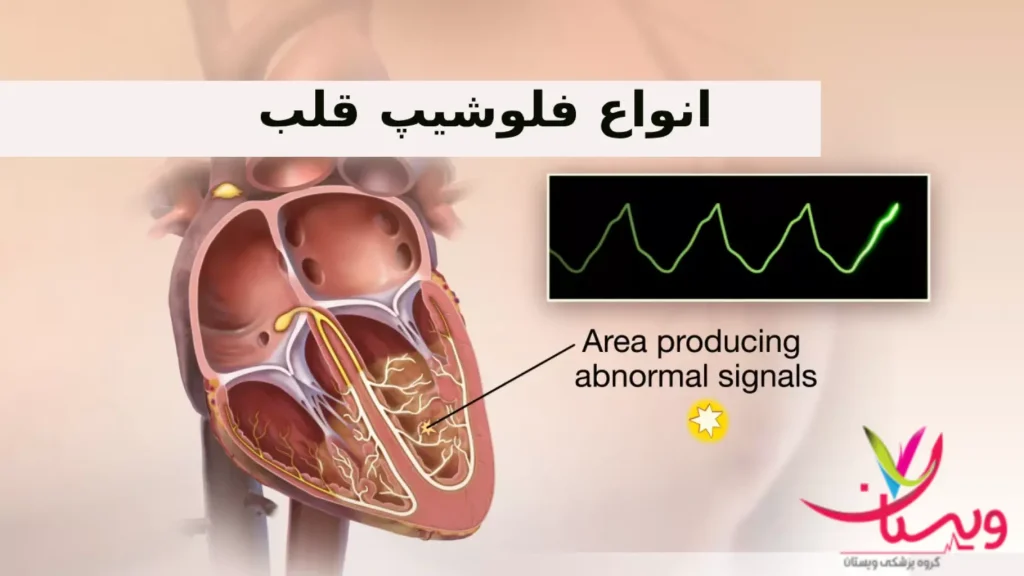 انواع فلوشیپ قلب ویستان انواع فلوشیپ قلب