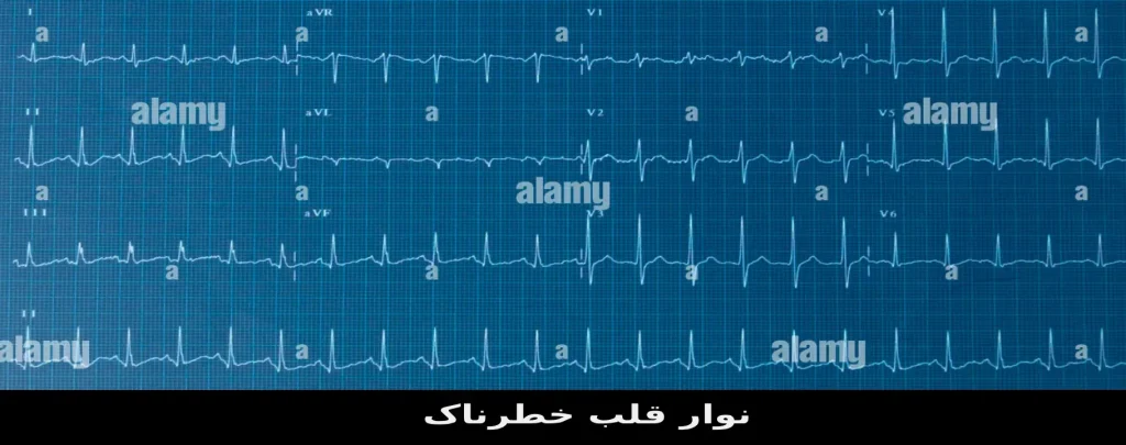 تفسیر نوار قلب خطرناک نوار قلب خطرناک