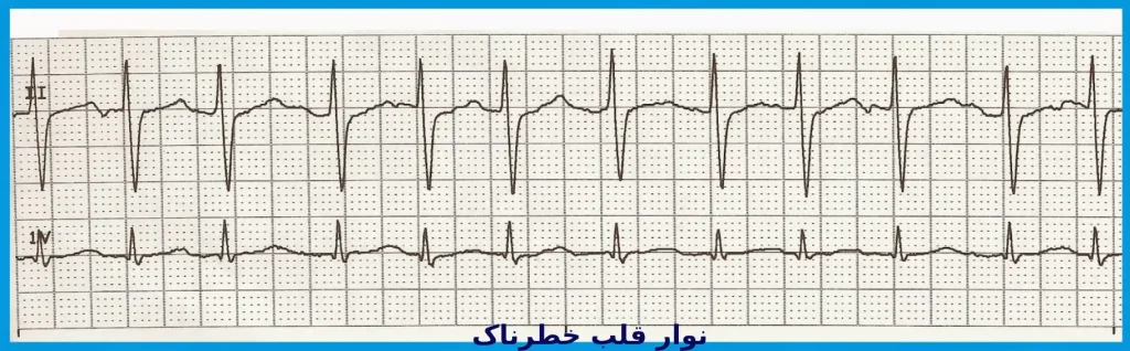 علائم نوار قلب خطرناک علائم و نشانههای خطرناک مشکلات قلبی در زنان