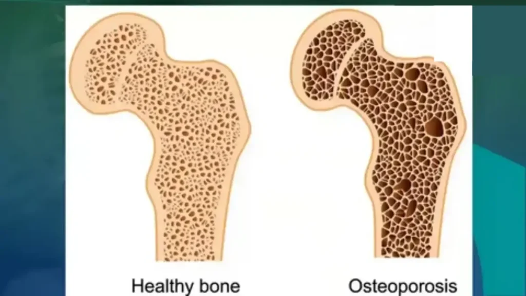 علائم پوکی استخوان علائم پوکی استخوان