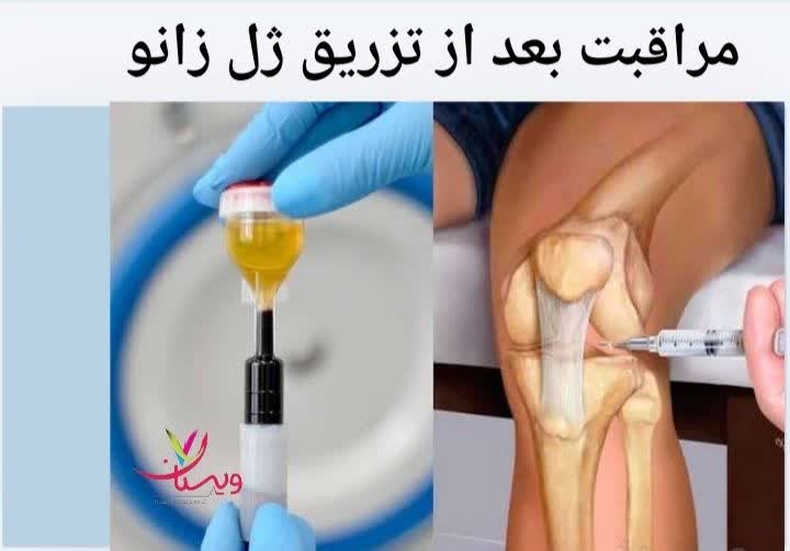 راهنمای مراقبت بعد از تزریق ژل به زانو مراقبت بعد از تزریق ژل زانو