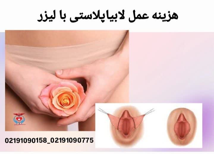 هزینه جراحی لابیاپلاستی با لیزر
