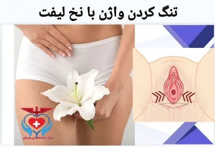تنگ کردن واژن با نخ لیفت