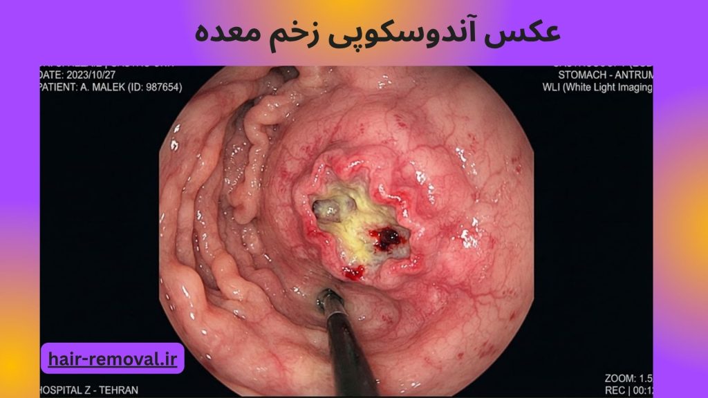 تصویری از زخم و آسیب مخاطی معده در آندوسکوپی