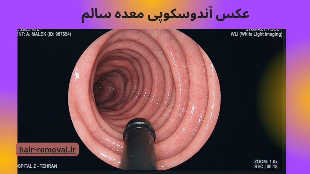 خواندن جواب ازمایش اندوسکوپی معده |عکس آندوسکوپی معده سالم