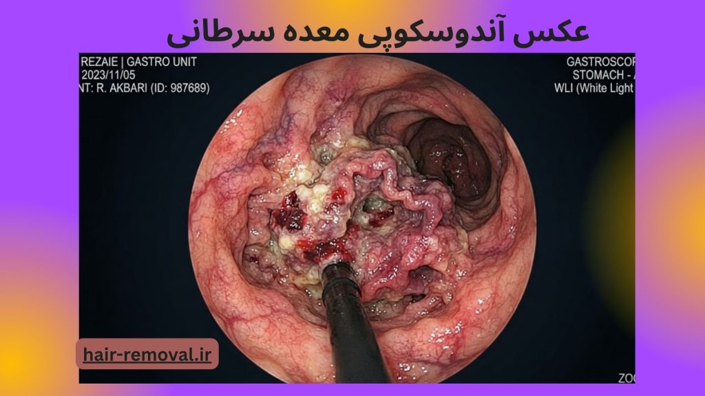 عکس آندوسکوپی معده سرطانی